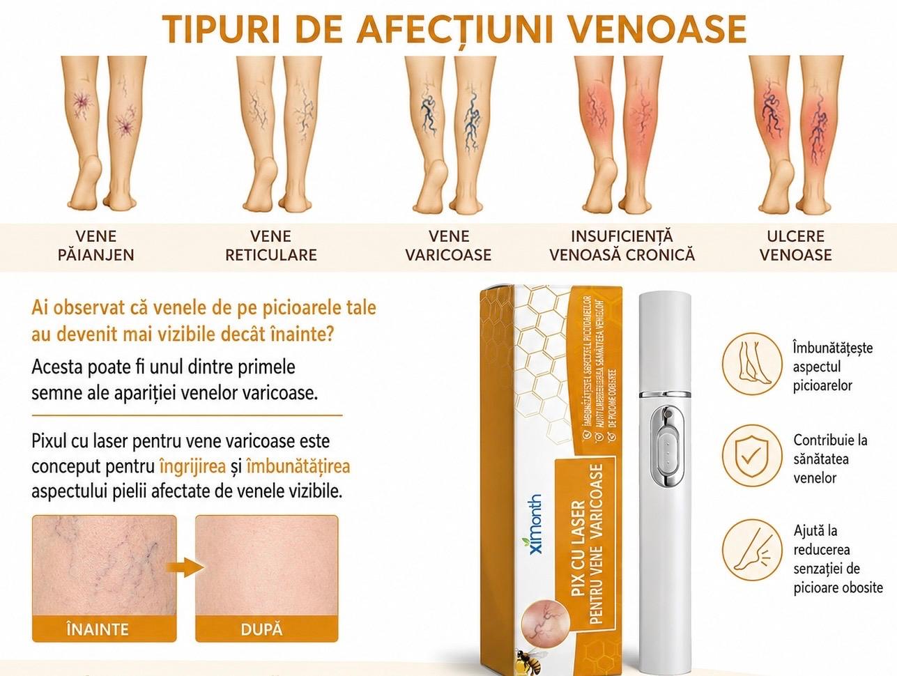 Aparat laser pentru varice si cosuri.