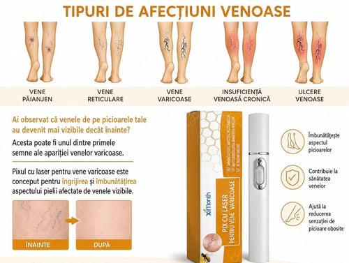 Aparat laser pentru varice si cosuri.